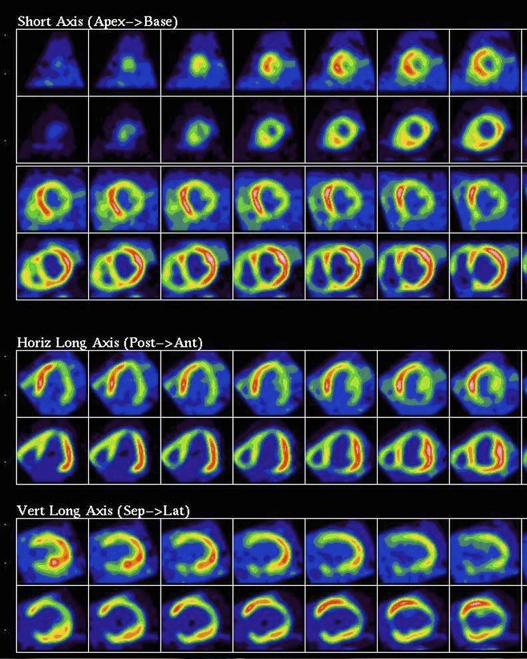 Nuclear stress test results review