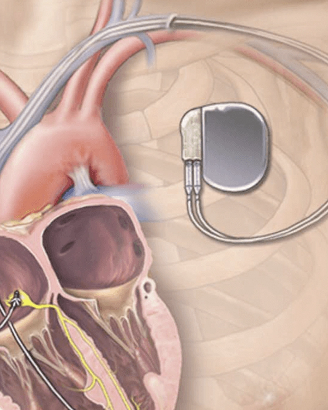 Pacemaker device check